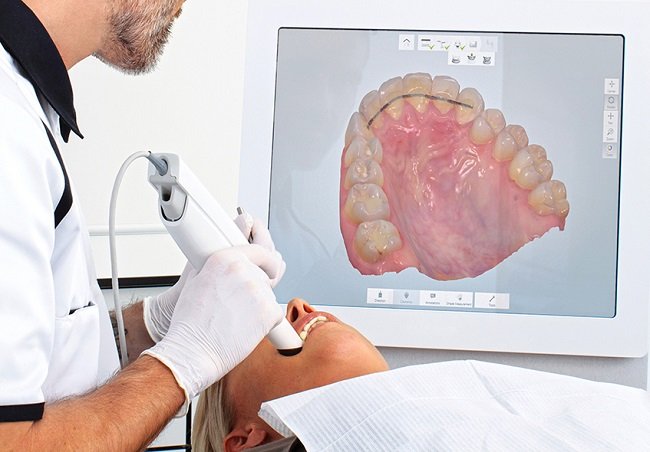 Intraoral scanning for digital dentures